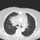 Pneumonia, mediastinitis, mediastinal abscess: CT - Computed tomography